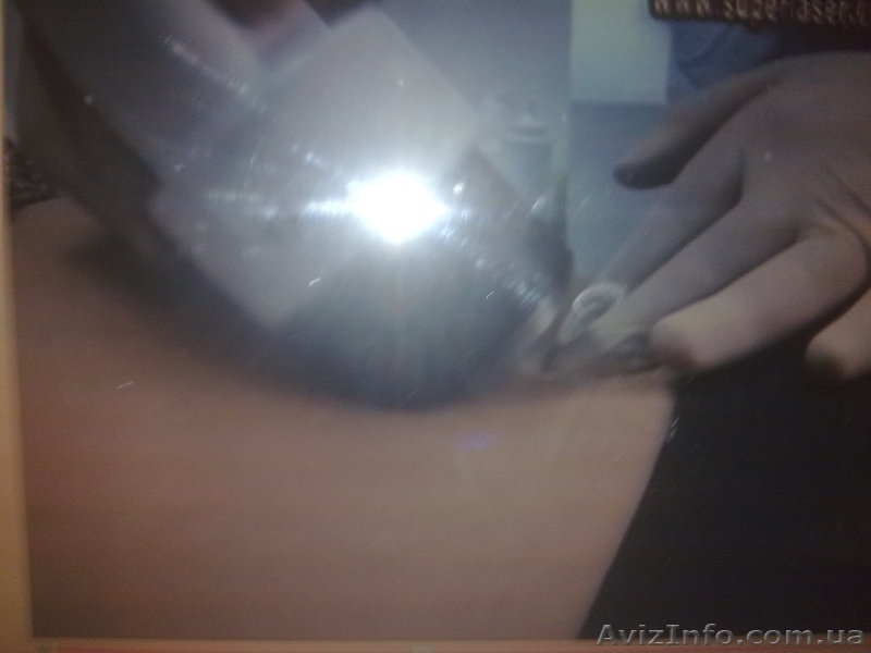 Лечение целлюлита и локал.жировых отложений.Радиолифтинг!Недорого. - <ro>Изображение</ro><ru>Изображение</ru> #3, <ru>Объявление</ru> #566404