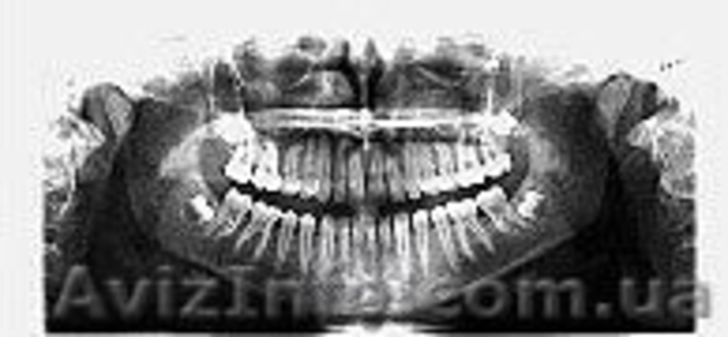 Панорамный рентгеновский аппарат PM 2002 CC Proline c цефалостатной приставкой P - <ro>Изображение</ro><ru>Изображение</ru> #6, <ru>Объявление</ru> #621589